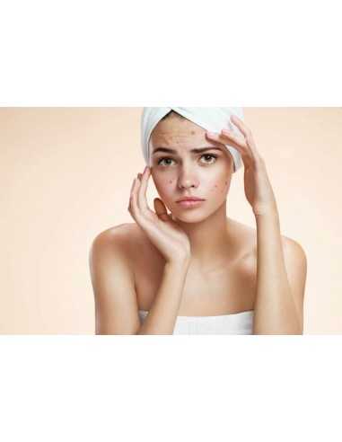 Anti Acné facial