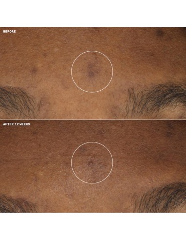 CLINIQUE EVEN BETTER CLINICAL...