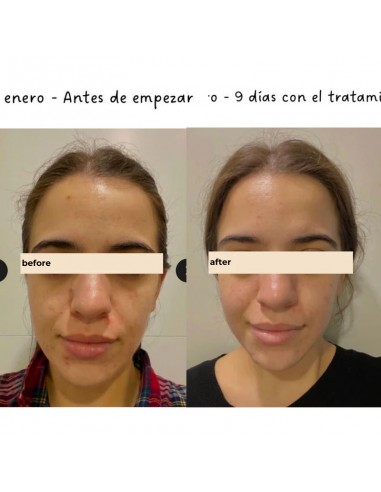 TWO POLES BLEMISH CONTROL TREATMENT 40ML