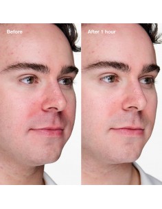 CLINIQUE ANTI BLEMISH... 2
